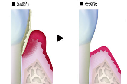 のて歯科クリニック歯周病治療イメージ