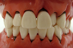 のて歯科クリニック歯周病末期症状